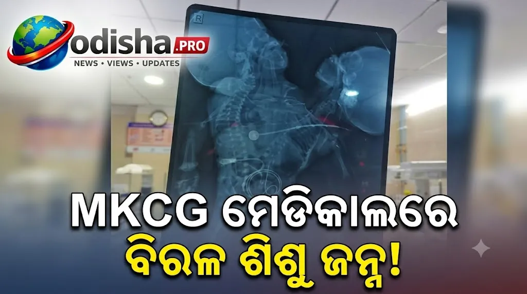 କନ୍ଧମାଳ ମହିଳାଙ୍କ ଗର୍ଭରୁ ଜନ୍ମ ନେଲା ଦୁଇଟି ମୁଣ୍ଡ ଥିବା ଶିଶୁ, MKCGରେ ଚାଲିଛି ଚିକିତ୍ସା
