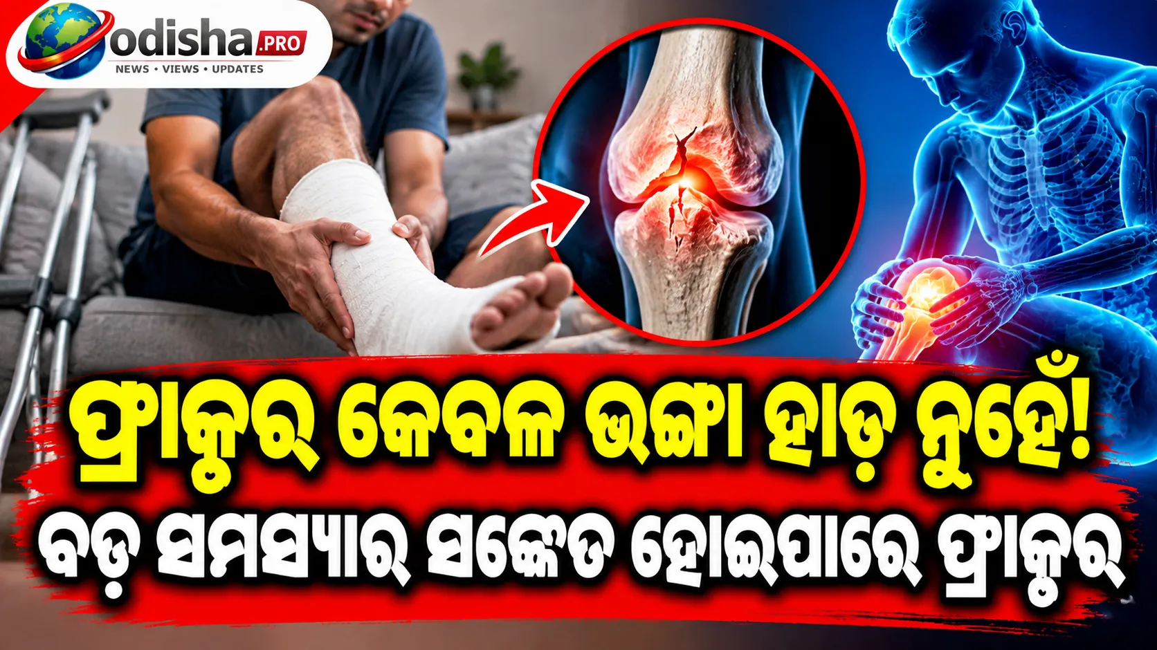 କେବଳ ହାଡ଼ ଭାଙ୍ଗିବା ନୁହେଁ, ବଡ଼ ସମସ୍ୟାର ସଙ୍କେତ ହୋଇପାରେ ଫ୍ରାକ୍ଚର୍