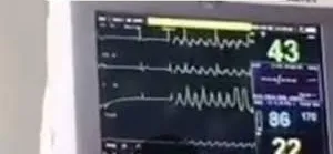 Can Someone Survive 30 Minutes of CPR? What Doctors Say