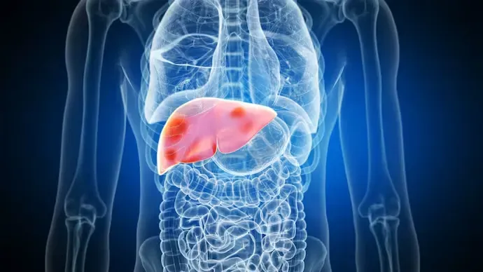 ବୃଦ୍ଧିଶୀଳ ଫ୍ୟାଟି ଲିଭର ରୋଗ ଆଶଙ୍କା: 2050 ସୁଦ୍ଧା 2 ବିଲିୟନ୍ ଲୋକ ପ୍ରଭାବିତ ହେବେ