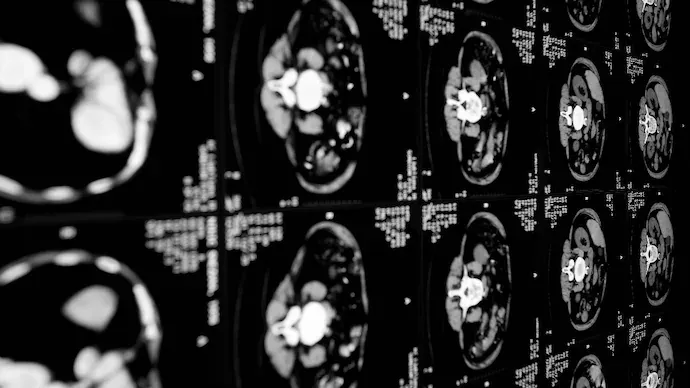 Mayo Clinicର AI tool pancreatic cancerକୁ ତିନି ବର୍ଷ ପୂର୍ବରୁ ଚିହ୍ନଟ କରିପାରେ, early detectionରେ ବଡ଼ breakthrough