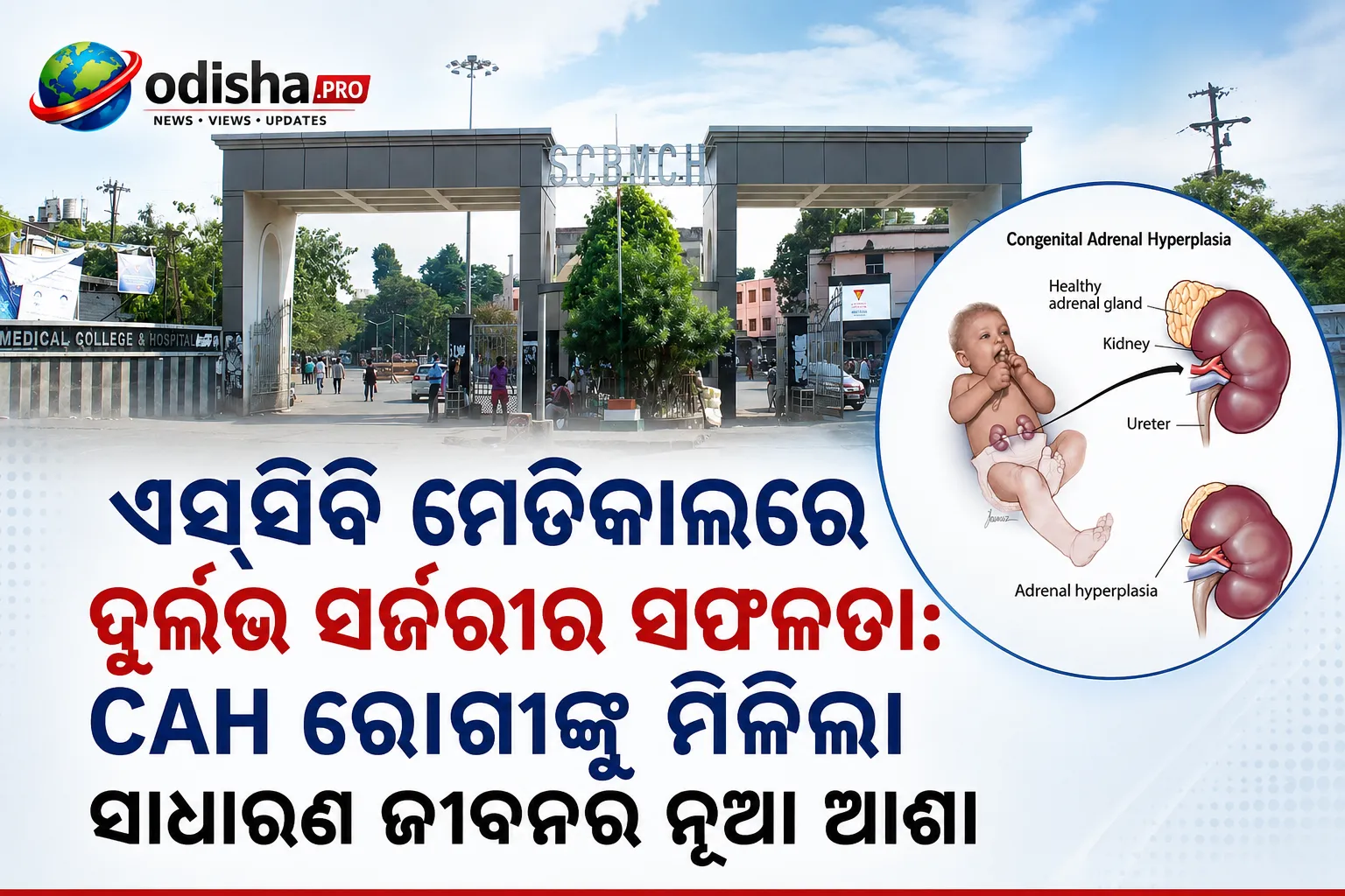 ଏସ୍‌ସିବି ମେଡିକାଲରେ ଦୁର୍ଲଭ ସର୍ଜରୀର ସଫଳତା: CAH ରୋଗୀଙ୍କୁ ମିଳିଲା ସାଧାରଣ ଜୀବନର ନୂଆ ଆଶା