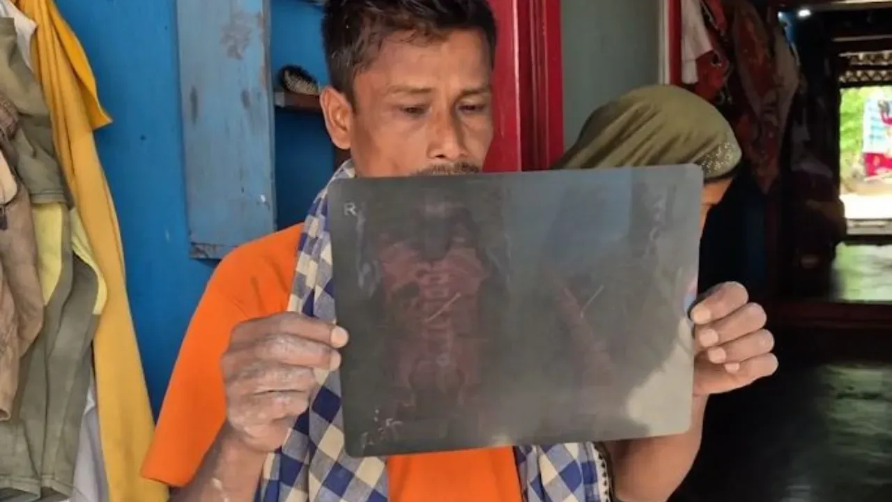 ଖେଳୁଥିବା ବେଳେ ଗିଳିଦେଲେ ଲୁହା କଣ୍ଟା, ୨୮ ଦିନ ହେଲା ପେଟରେ; ସରକାରୀ ସହାୟତା ଲୋଡ଼ିଲେ ପରିବାର