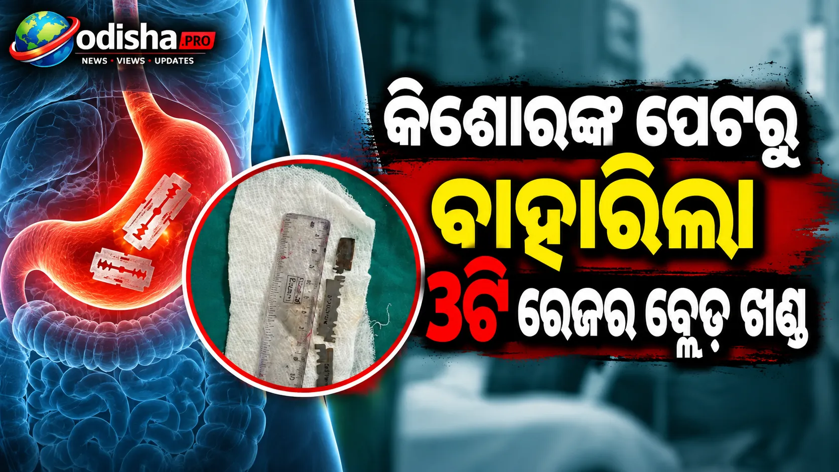 କିଶୋରଙ୍କ ପେଟରୁ ବାହାରିଲା ୩ଟି ରେଜର ବ୍ଲେଡ୍ ଖଣ୍ଡ, ଜଟିଳ ଏଣ୍ଡୋସ୍କୋପିକ୍ ପ୍ରକ୍ରିୟାରେ ସଫଳ ହେଲା ଅପରେସନ୍